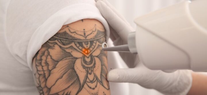 Tattoo Removal