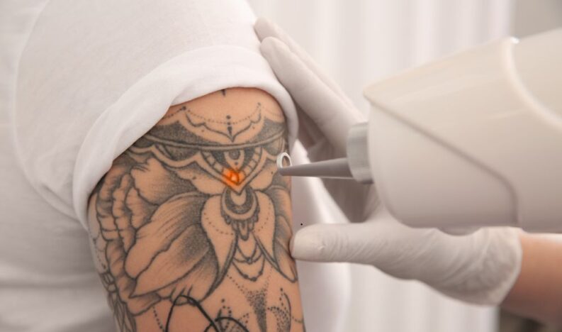 Tattoo Removal