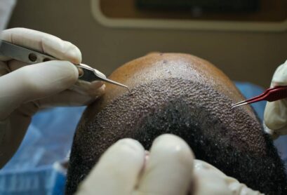 hair transplant