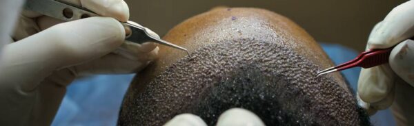 hair transplant