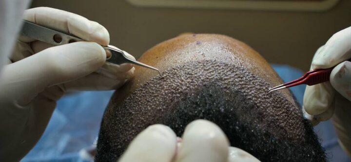 hair transplant