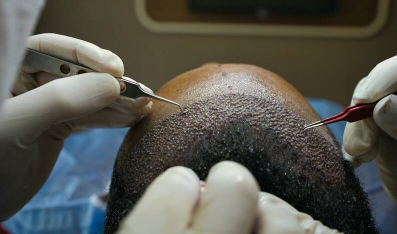 hair transplant